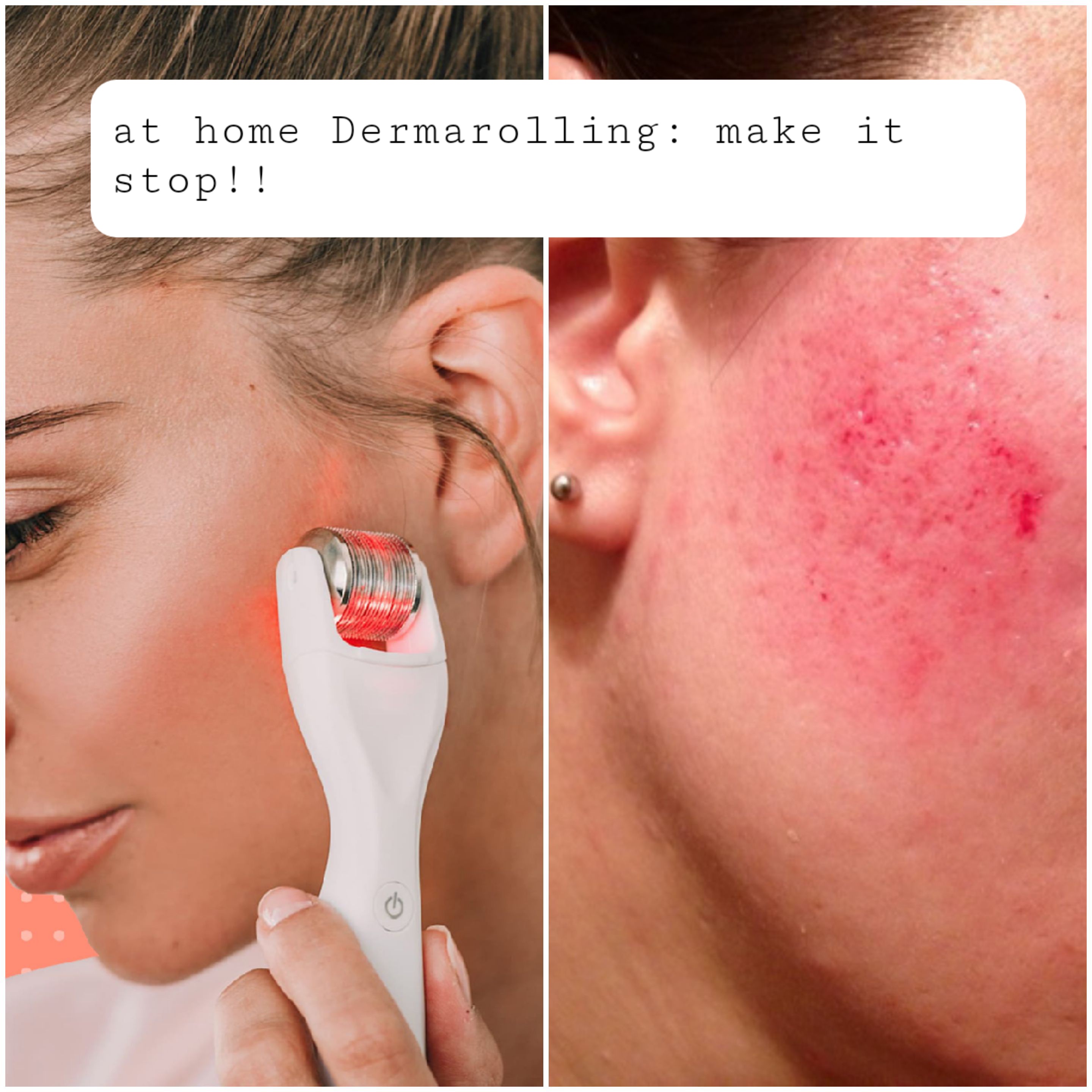 Damaging the Skin to heal it? Dermaroller TRUTH