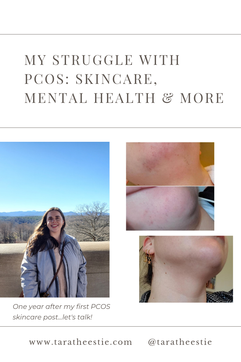 My Struggle With PCOS: Skincare, Mental Health & More