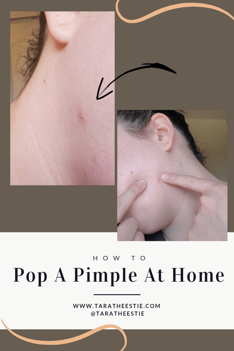 How To Pop A Pimple Correctly | From A Licensed Esthetician
