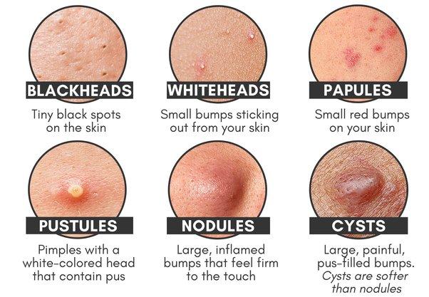 Types of Acne | Popping Pimple at Home | @taratheestie